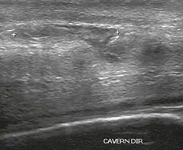 Figure 4 A: Ultrasound of the penis, right lateral view. Longitudinal section showing rupture of the tunica albuginea with an adjacent 1.92&nbsp;cm hematoma (between calipers), due to trauma.