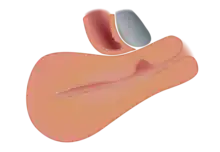 A uterus with a niche