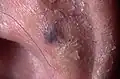 Venous lake of the ear