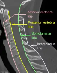 CT scan of normal congruous vertebral lines