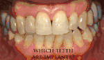 Mouth with many implant supported teeth where it is difficult to distinguish the real teeth from the prosthetic teeth.