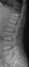 X-ray of a subtle "rugger jersey spine" due to sclerotic bands adjacent to the vertebral endplates.
