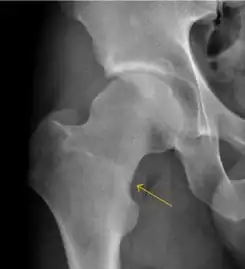 Stress femoral neck fracture in a young athlete barely visible in X-ray film as a sclerotic line (arrow)