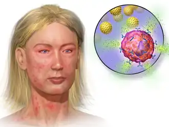 Anaphylaxis.