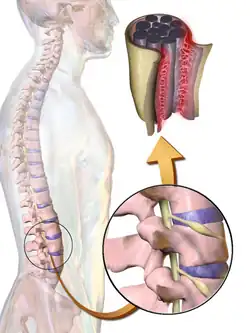 Arachnoiditis.