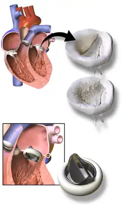 Artificial heart valve of St. Francis model