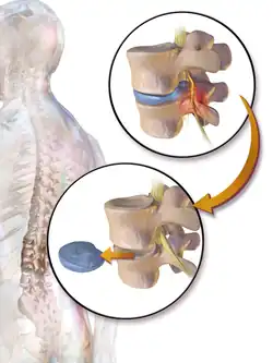 Discectomy.