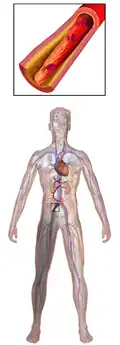 Peripheral artery disease.